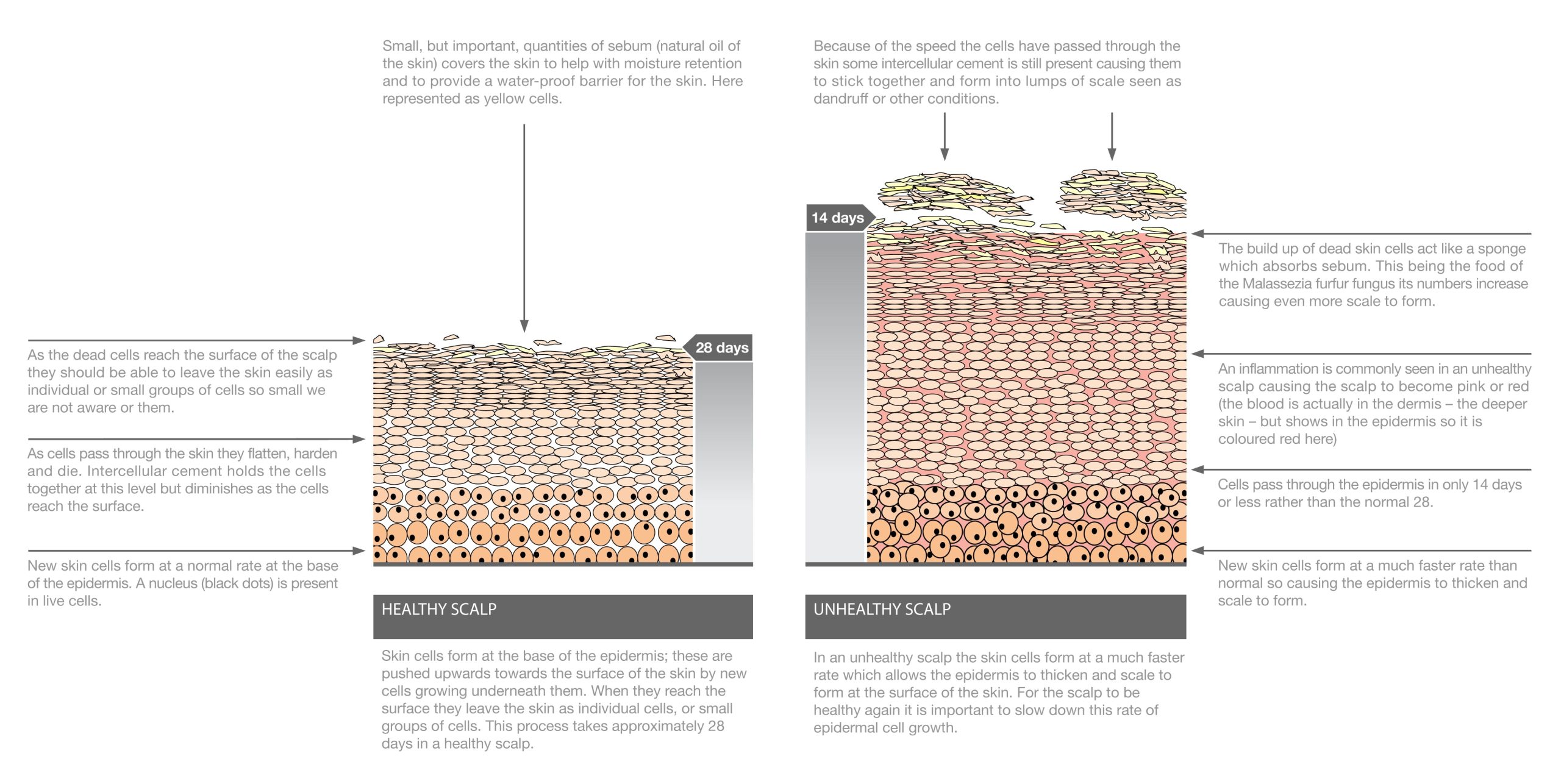 What is Seborrheic Dermatitis